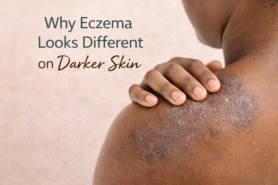 A close-up image of eczema-affected skin on a person with a deeper skin tone, showing subtle inflammation, dryness, and texture changes rather than visible redness.