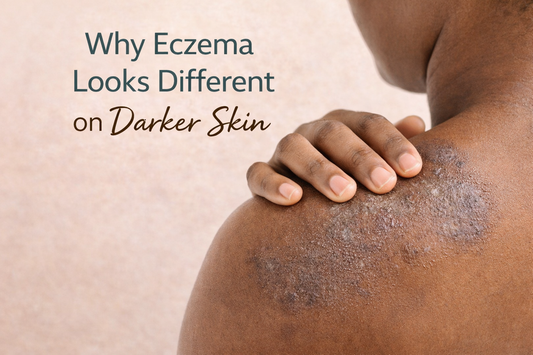 A close-up image of eczema-affected skin on a person with a deeper skin tone, showing subtle inflammation, dryness, and texture changes rather than visible redness.